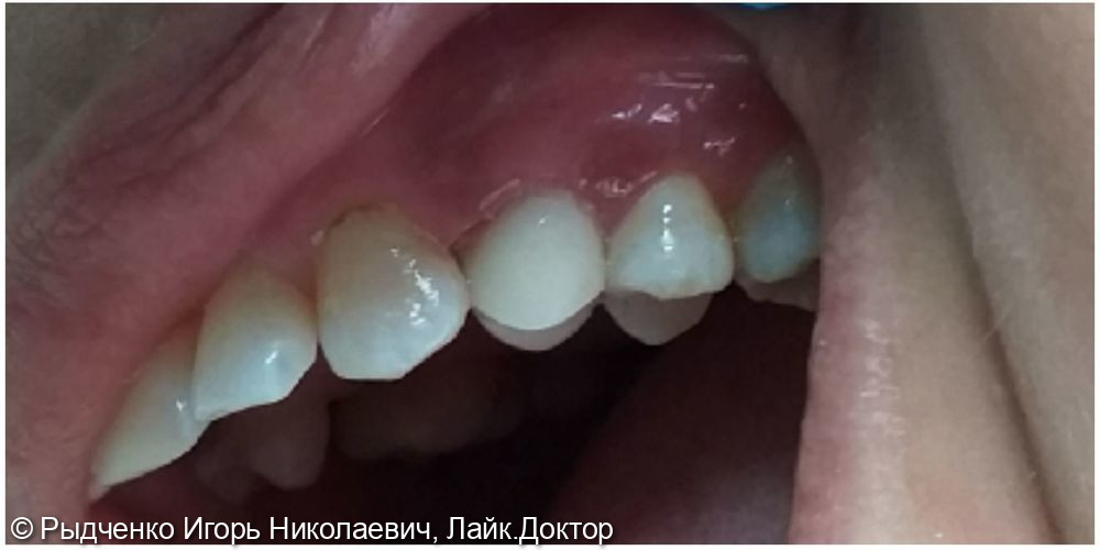 Восстановление полностью разрушенного зуба 2.4 на основе сохранённых, пролеченных корней - фото №3
