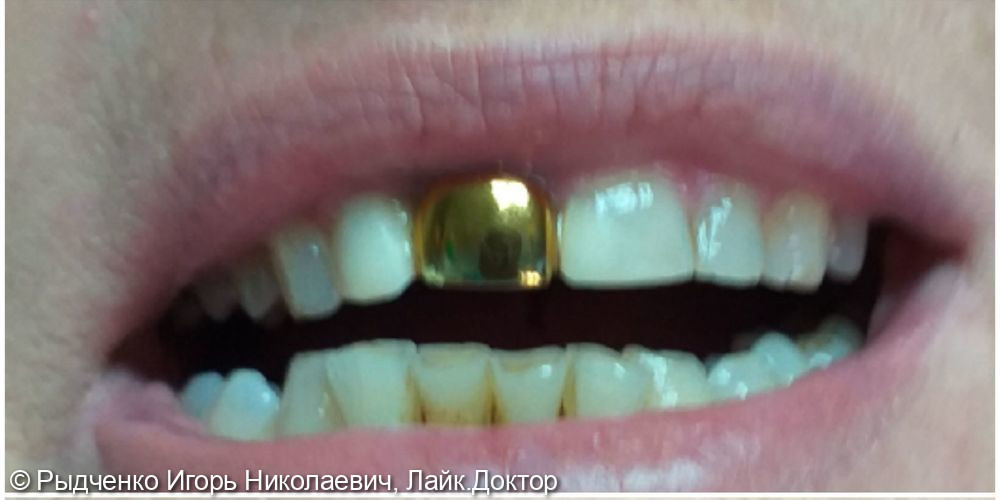 Реставрация 1.1 зуба после снятия металической коронки - фото №1