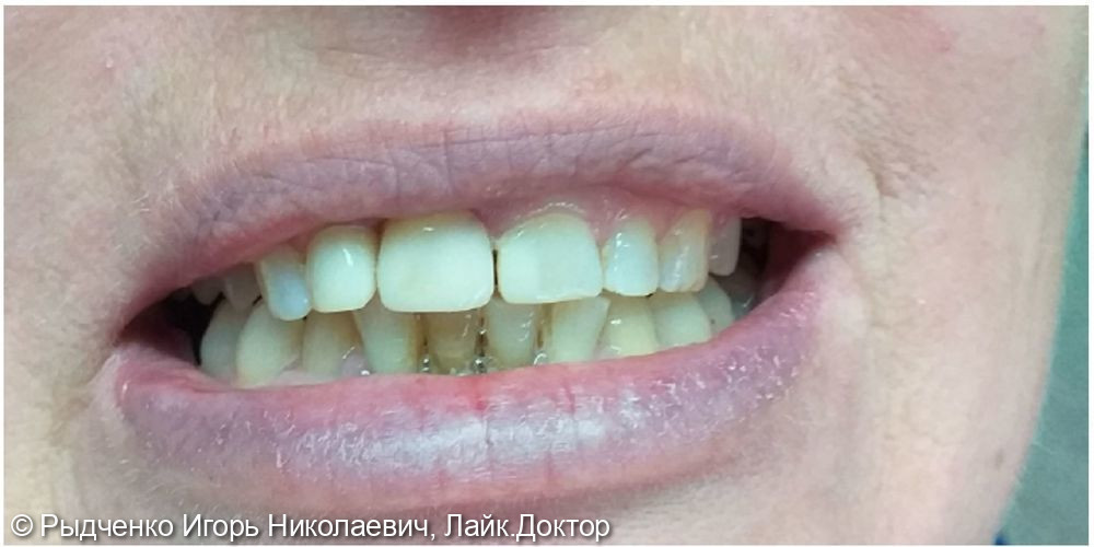 Реставрация 1.1 зуба после снятия металической коронки - фото №3