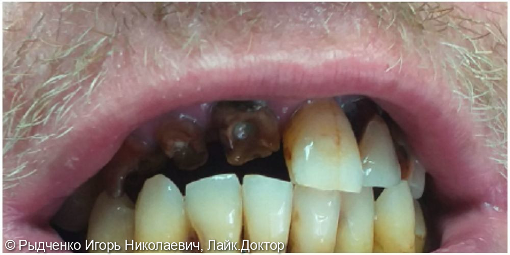 Эндодонтическое лечение 1.3, 1.2, 1.1 зубов, с последующим восстановлением из светокомпозита - фото №1