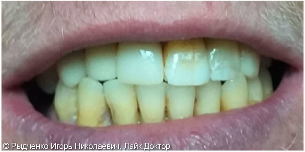 Эндодонтическое лечение 1.3, 1.2, 1.1 зубов, с последующим восстановлением из светокомпозита - фото №6