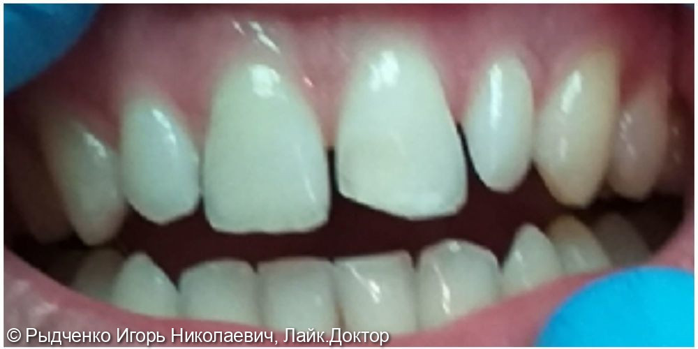 Реставрация режущего края 2.1 зуба светокомпозитом - фото №1