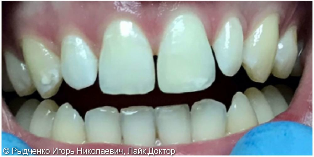 Реставрация режущего края 2.1 зуба светокомпозитом - фото №2