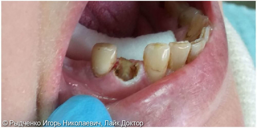 Реставрация, наращивание сломанного 4.4. зуба из светокомпозита - фото №1