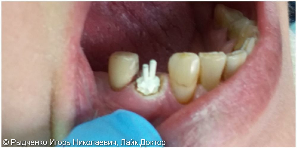 Реставрация, наращивание сломанного 4.4. зуба из светокомпозита - фото №2