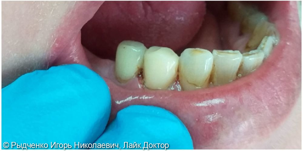 Реставрация, наращивание сломанного 4.4. зуба из светокомпозита - фото №3