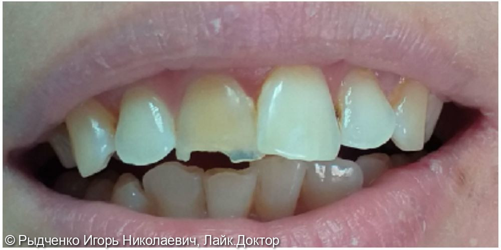 Эндодонтическое лечение хронического периодонтита 1.1. зуба - фото №1