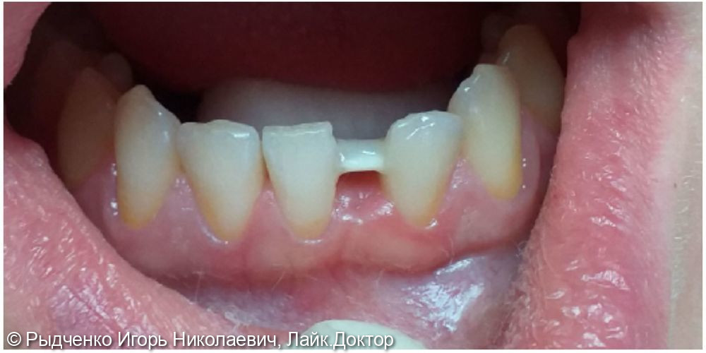 Микропротезирование с применением адгезивной стекловолоконной техники восстановления зубов - фото №2