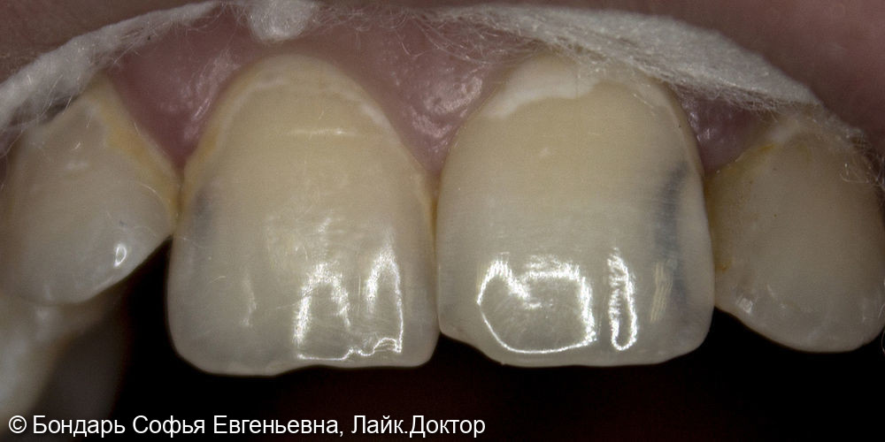 Эстетическая реставрация фронтальной группы зубов - фото №1