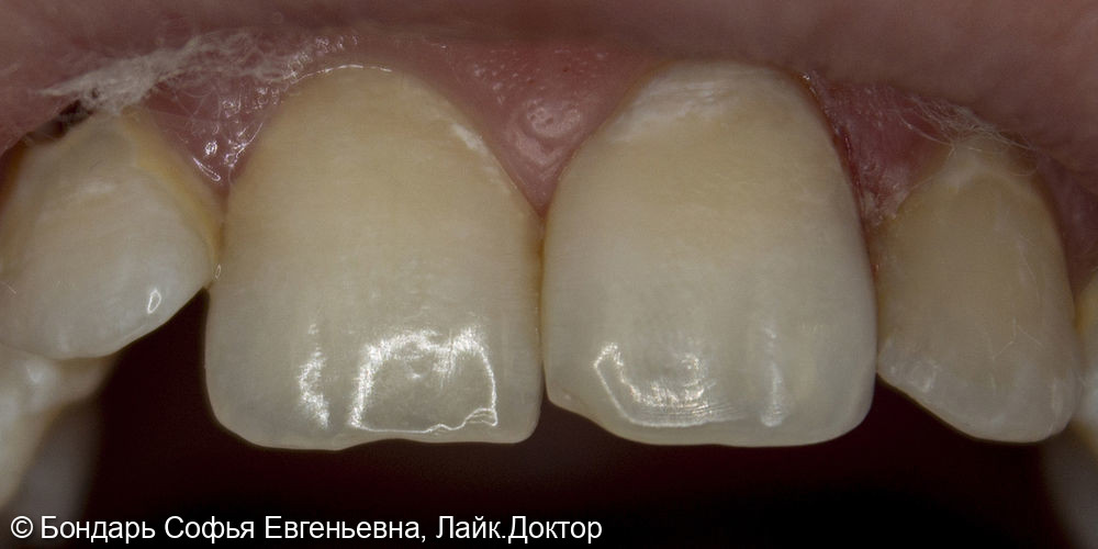 Эстетическая реставрация фронтальной группы зубов - фото №2