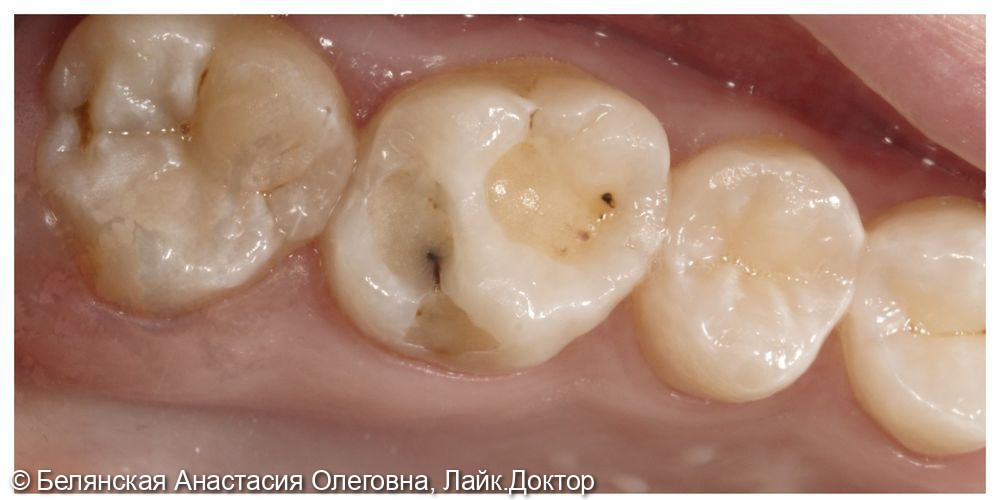 Лечение кариеса на жевательной поверхности 2.6 зуба - фото №1