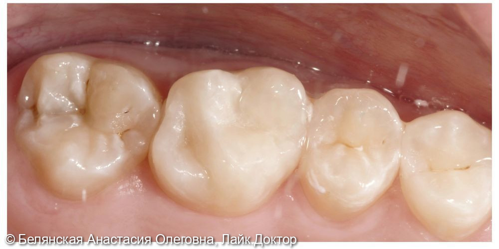 Лечение кариеса на жевательной поверхности 2.6 зуба - фото №2