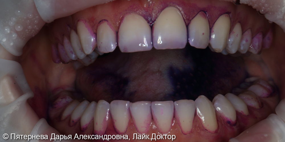 Профессиональная гигиена полости рта. Отбеливание зубов - фото №1