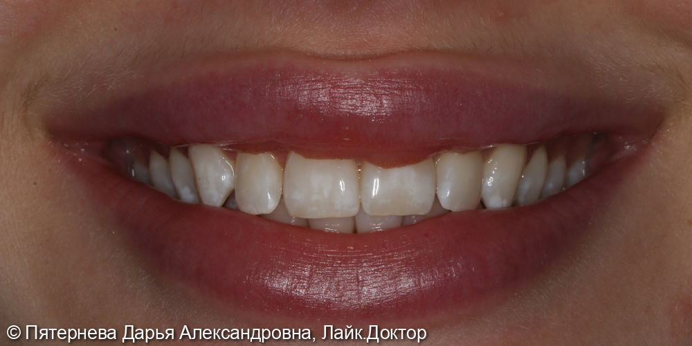 Профессиональная гигиена полости рта. Отбеливание зубов - фото №5