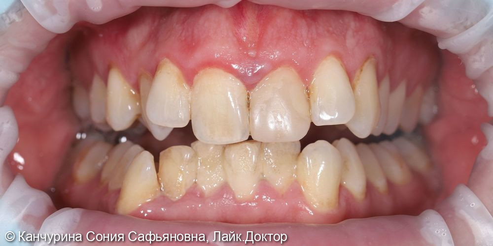 Профессиональная гигиена полости рта - фото №1