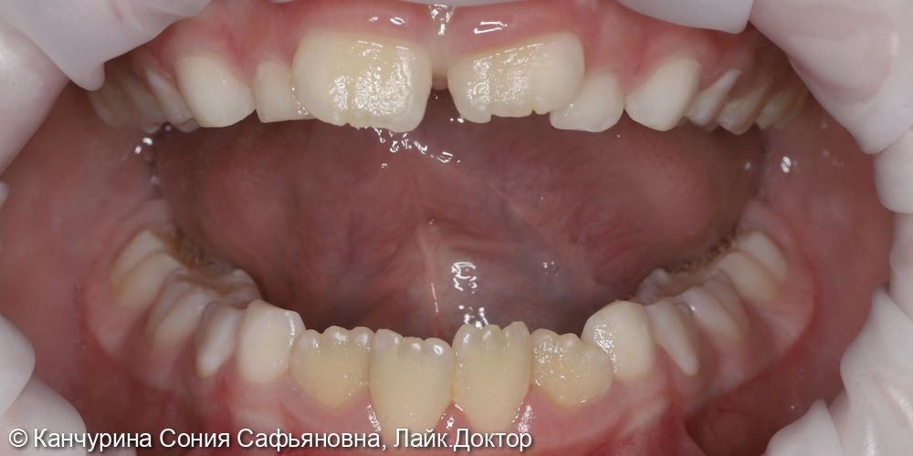 Профессиональная гигиена полости рта - фото №1