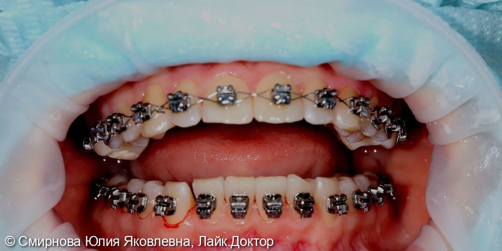 Плановая проф. гигиена пациента, находящегося на ортодонтическом лечении - фото №3