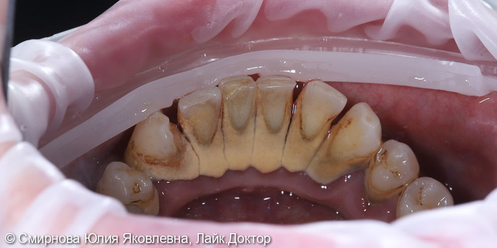 Профессиональная чистка зубов - фото №2