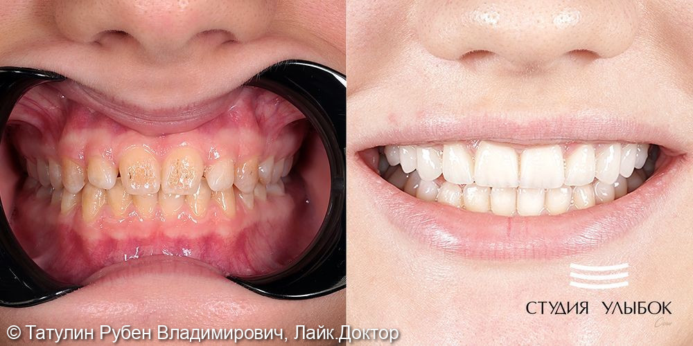 Установка 10-ти керамических виниров E.Max (цвет А1) на верхню челюсть и отбеливание зубов нижней челюсти Zoom-4 (фронтальная група) - фото №1