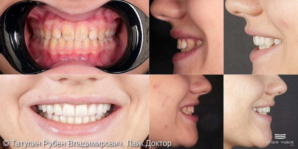 Установка 10-ти керамических виниров E.Max (цвет А1) на верхню челюсть и отбеливание зубов нижней челюсти Zoom-4 (фронтальная група) - фото №2
