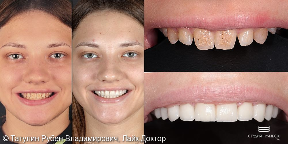 Установка 10-ти керамических виниров E.Max (цвет А1) на верхню челюсть и отбеливание зубов нижней челюсти Zoom-4 (фронтальная група) - фото №3