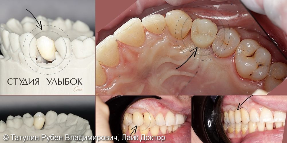 Протезирование одиночного зуба 14 после имплантации (коронка из диоксида циркония с нанесением керамики) - фото №1
