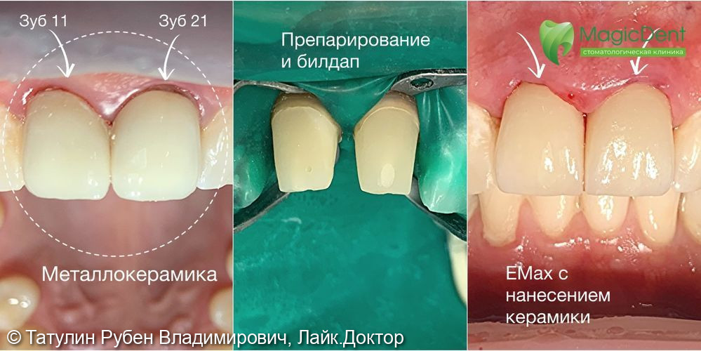 Замена металлокерамической коронки на коронку E.Max - фото №1