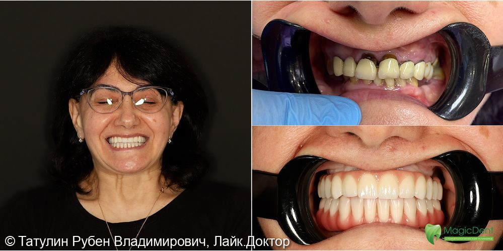 Клинический случай тотального протезирования на имплантатах верхней и нижней челюсти - фото №2