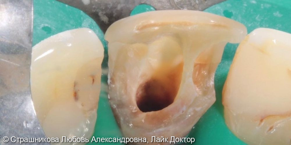 Пациентку не устраивал цвет зуба, 20 лет назад был обнаружен осложнённый кариес, после чего возник дефект эмали - фото №1