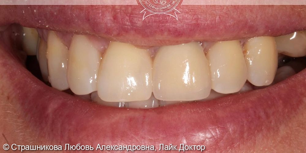 Пациентку не устраивал цвет зуба, 20 лет назад был обнаружен осложнённый кариес, после чего возник дефект эмали - фото №4