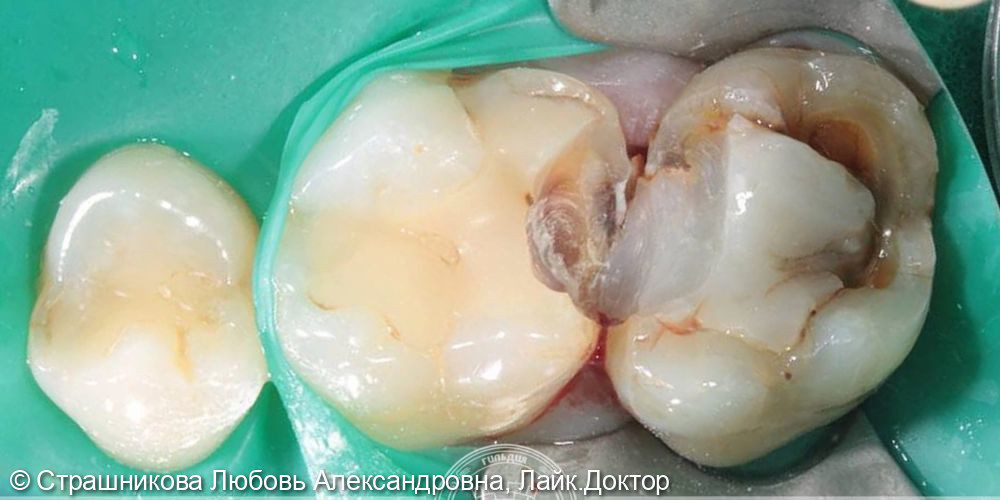 Жалобы пациента на разрушение зуба, застревание пищи и боли при жевании - фото №1