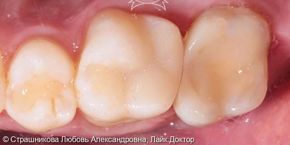 Жалобы пациента на разрушение зуба, застревание пищи и боли при жевании - фото №2