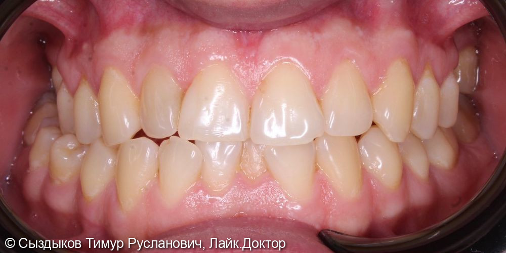 Ортодонтическая подготовка к имплантации и протезированию - фото №1
