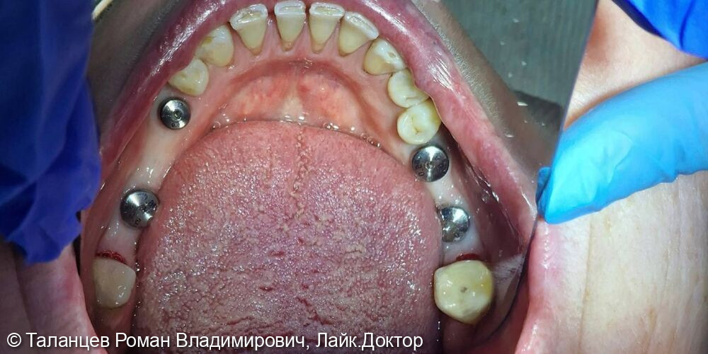 Имплантация Neobiotech - фото №1