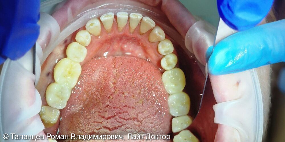 Имплантация Neobiotech - фото №3
