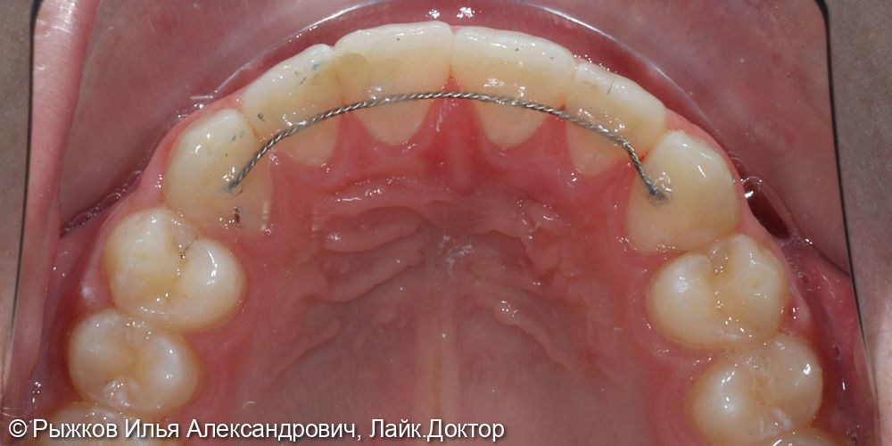 Лечение на брекетах - фото №8