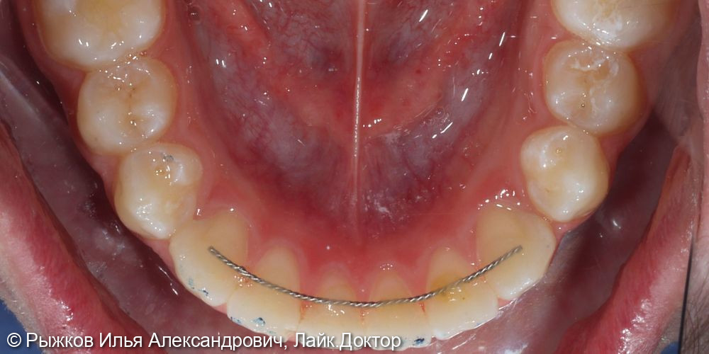 Лечение на брекетах - фото №10