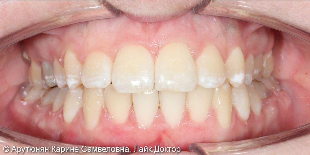 Лечение с помощью комбинированной брекет-системы на обе челюсти - фото №2
