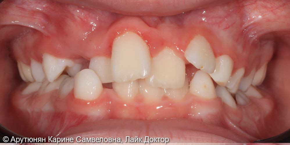 Ортодонтическое лечение - фото №1
