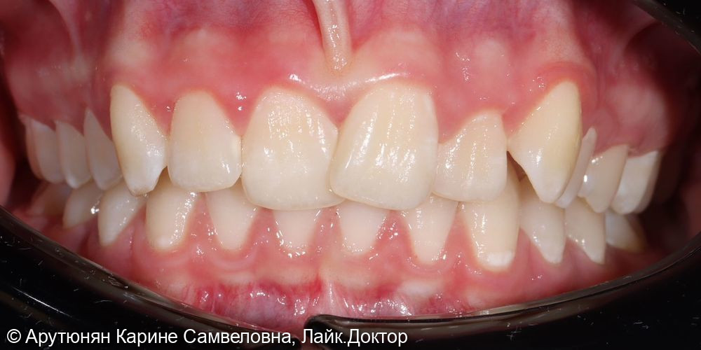 Брекет-система - фото №1