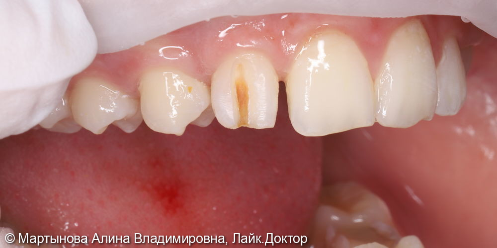 Лечение зуба фото 2 · Вологда