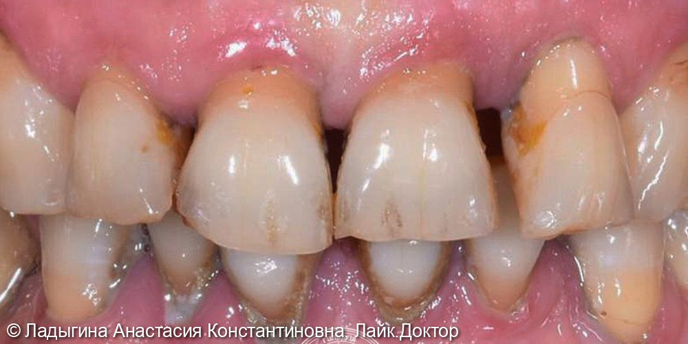 К стоматологу-ортопеду Анастасии Константиновне Ладыгиной обратилась пациентка с жалобой на разрушение и подвижность зубов, сложность в употреблении пищи из-за боли при накусывании - фото №1