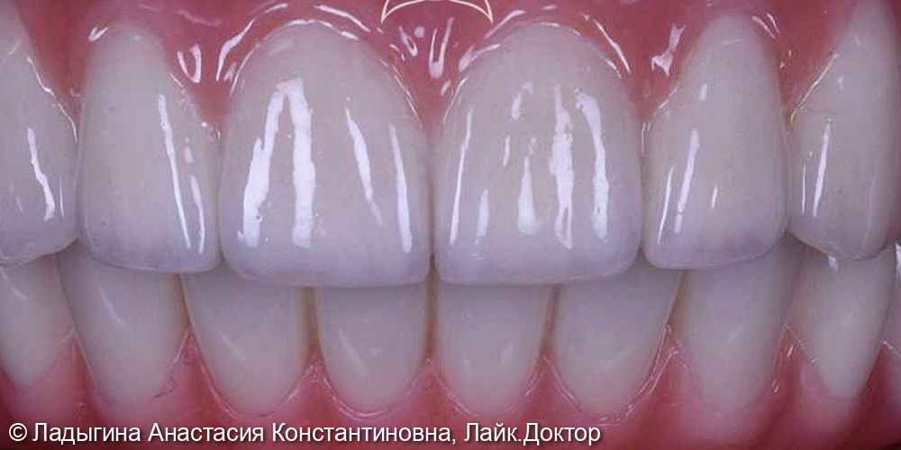 К стоматологу-ортопеду Анастасии Константиновне Ладыгиной обратилась пациентка с жалобой на разрушение и подвижность зубов, сложность в употреблении пищи из-за боли при накусывании - фото №2