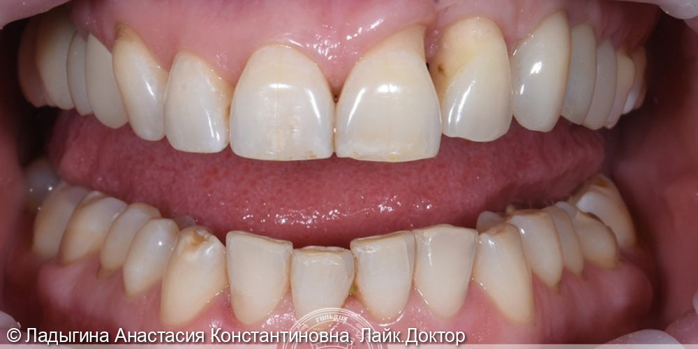 Комплексное лечение зубов - фото №1