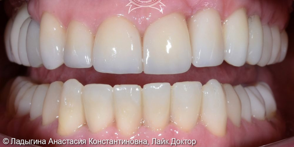 Комплексное лечение зубов - фото №2