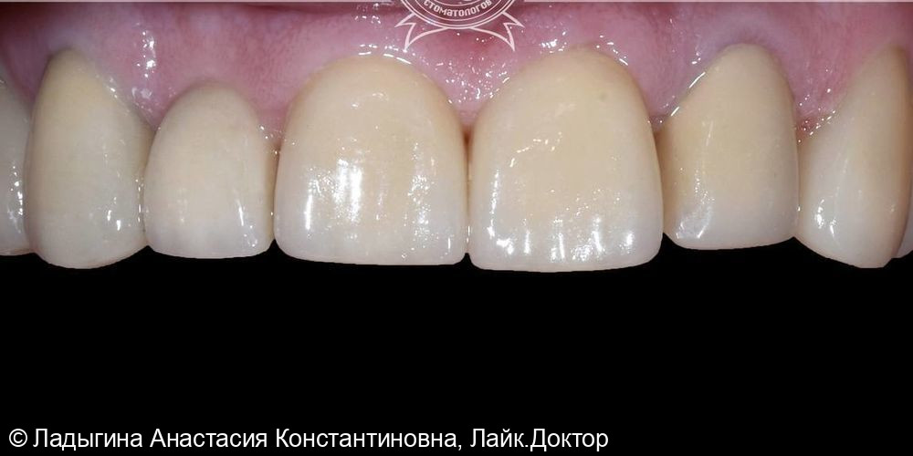 Пациент обратился с жалобами на эстетику и несостоятельность зубов - фото №2