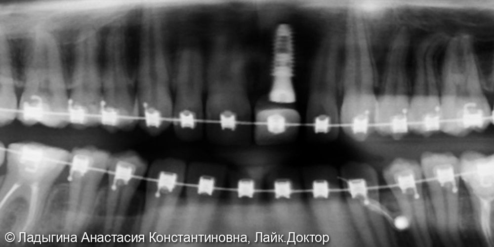 Из Мальты в Санкт-Петербург за комплексным лечением в «Гильдию стоматологов» - фото №1