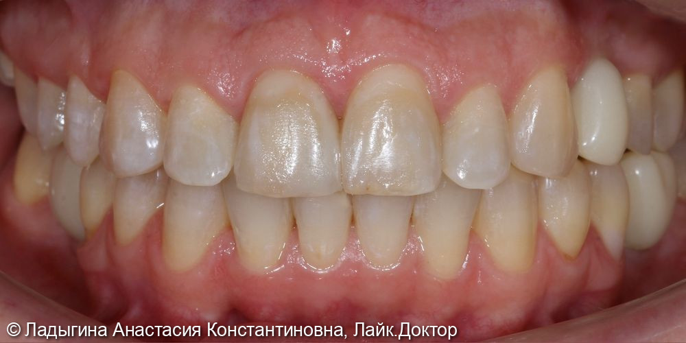 Эстетическое преображение центральной группы зубов с помощью виниров - фото №1