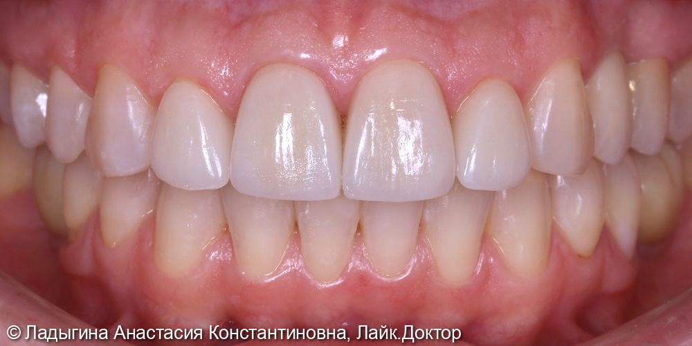 Эстетическое преображение центральной группы зубов с помощью виниров - фото №2