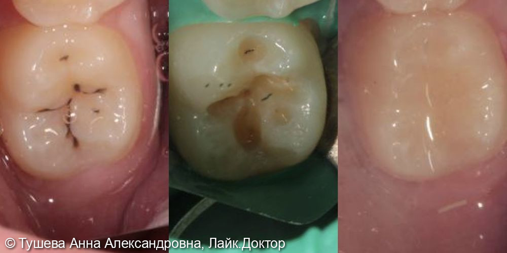 Лечение кариеса - фото №1